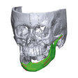 3D implantát - sánkové implantáty