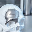 3D implantáty - kraniálne implantáty