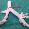 Obr. 8 Umiestnenie dlahy vytlačenej 4D tlačou na dýchacie cesty pacienta. Odliatok s nasadenou dlahou.