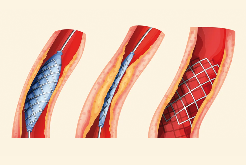 Obr. 6 Stent, ktorý sa v prípade zúženia cievy zväčší a zabráni tak jej upchatiu.